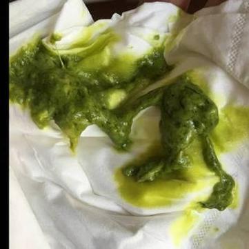 新生儿拉绿色便便是消化不良还是疾病信号?家长该如何应对?-第3张图片-郑州医学网 新生儿拉绿色便便是消化不良还是疾病信号?家长该如何应对?-第3张图片-郑州医学网