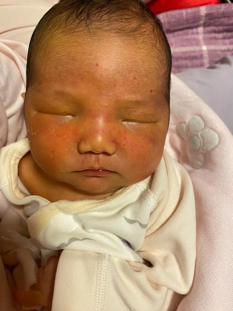 新生儿晒黄疸脸晒红了,晒黄疸的正确方法和注意事项是什么?-第1张图片-郑州医学网 新生儿晒黄疸脸晒红了,晒黄疸的正确方法和注意事项是什么?-第1张图片-郑州医学网