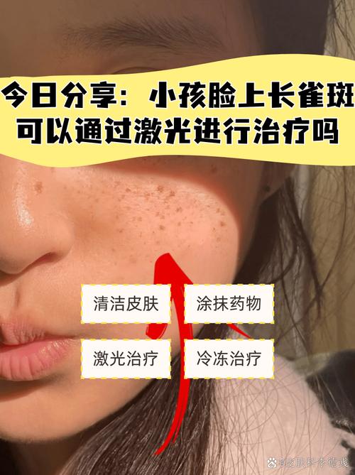 儿童脸上长斑是什么原因？该如何科学有效解决？-第1张图片-郑州医学网