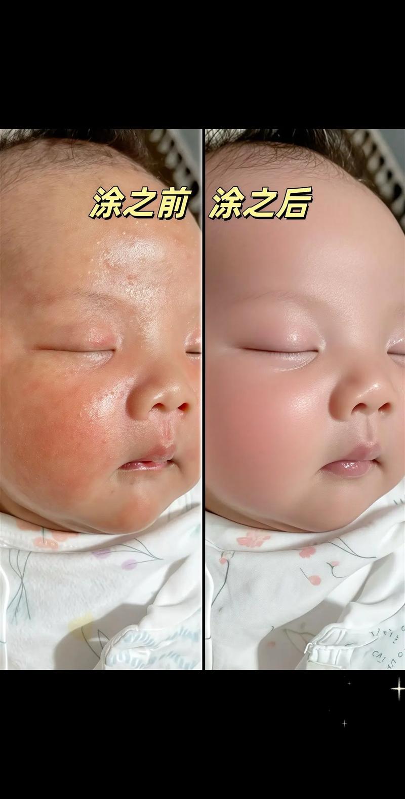 新生儿脸部需要抹油吗-第1张图片-郑州医学网 新生儿脸部需要抹油吗-第1张图片-郑州医学网