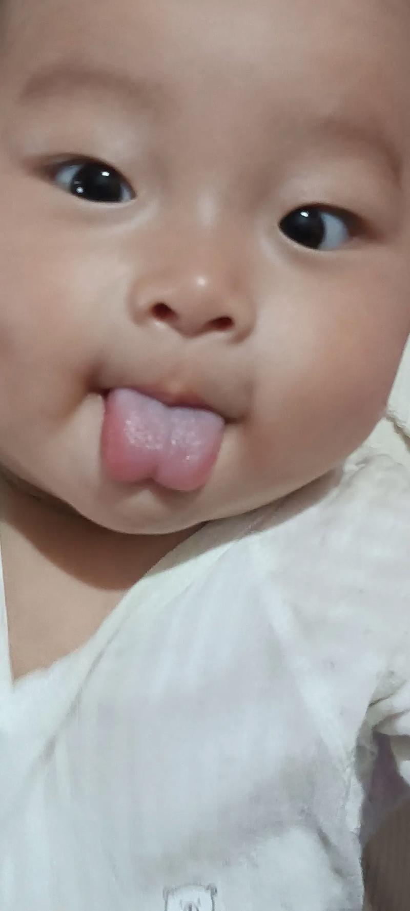 新生儿舌苔白厚正常吗-第2张图片-郑州医学网