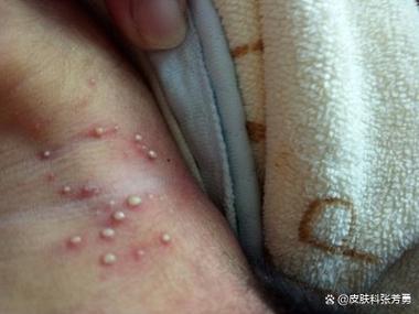 新生儿脓包疹到底有没有危险？家长该如何应对才能避免风险？-第2张图片-郑州医学网
