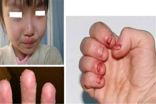 儿童咬指甲的恐怖图片-第2张图片-郑州医学网