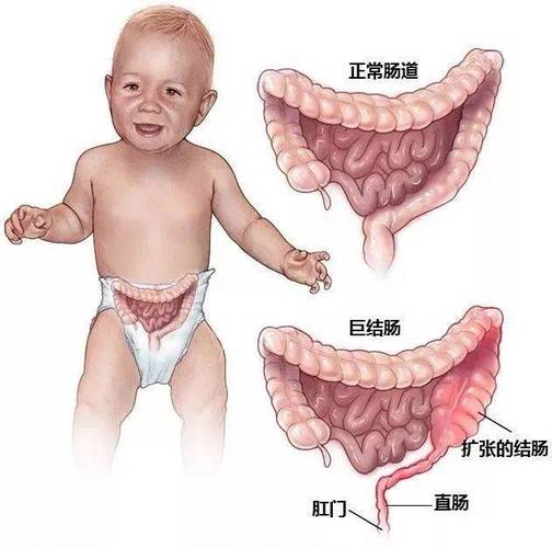 新生儿结肠坏死治愈率高吗？治疗后会有后遗症吗？-第2张图片-郑州医学网