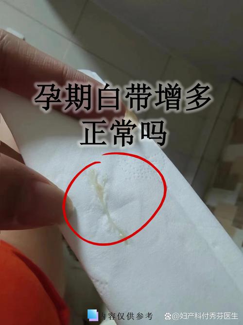 孕期大便时用力为何白带会增多？这是孕期正常的生理反应吗？-第1张图片-郑州医学网