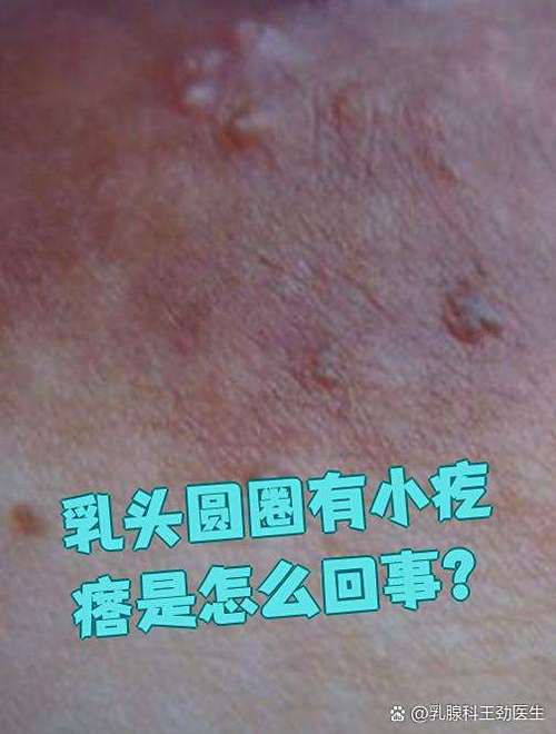 孕期乳头上长了小疙瘩是正常的吗？需要担心吗？-第2张图片-郑州医学网