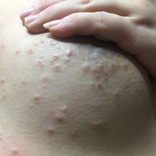 孕期乳头上长了小疙瘩是正常的吗？需要担心吗？-第1张图片-郑州医学网