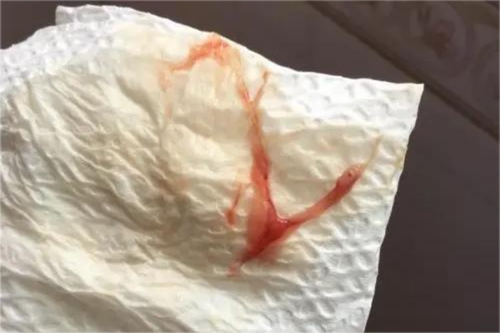 孕期宫颈糜烂出血，是正常现象还是危险信号？-第1张图片-郑州医学网