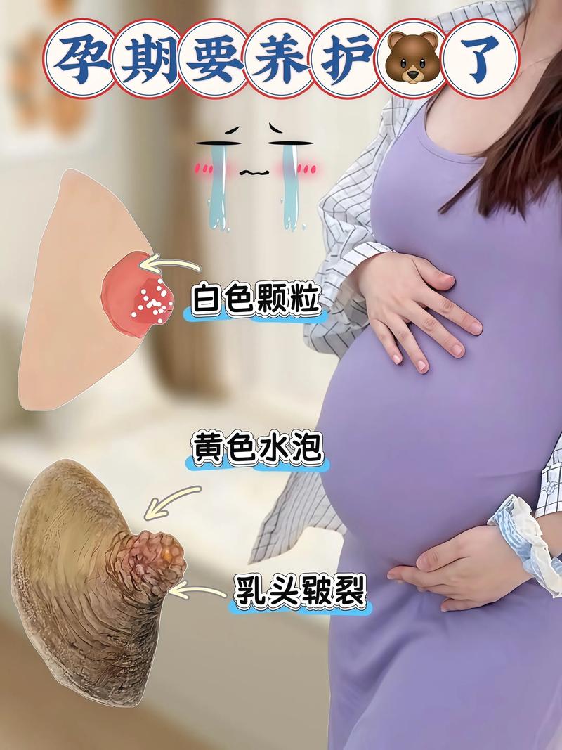 孕期如何有效预防乳头皲裂，有哪些实用方法能避免哺乳疼痛？-第3张图片-郑州医学网