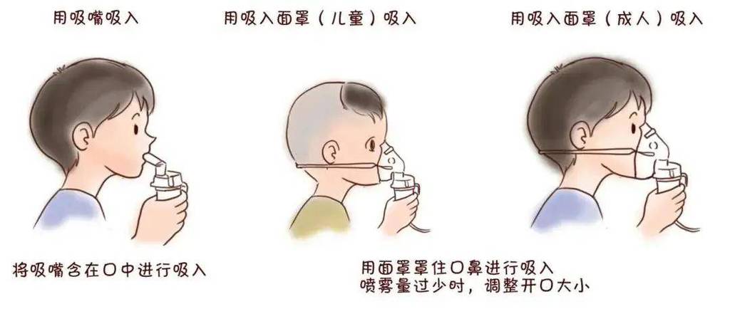 新生儿肺炎雾化治疗选什么药？雾化时间与频率怎么把控才安全？-第3张图片-郑州医学网