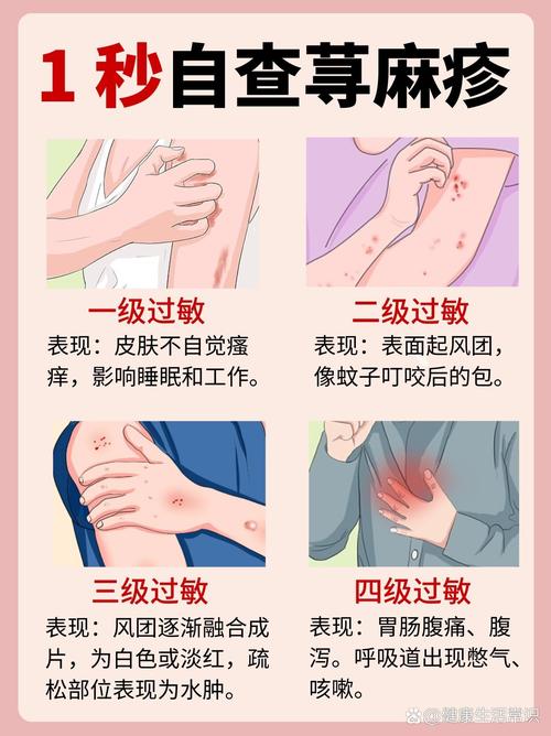 孕期荨麻疹反复发作,如何安全缓解不适又不会影响胎儿健康?-第3张图片-郑州医学网 孕期荨麻疹反复发作,如何安全缓解不适又不会影响胎儿健康?-第3张图片-郑州医学网