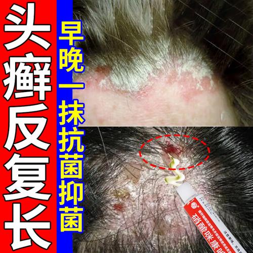 儿童头皮癣用药需谨慎，哪种药既安全又高效？家长该如何正确选择？-第1张图片-郑州医学网
