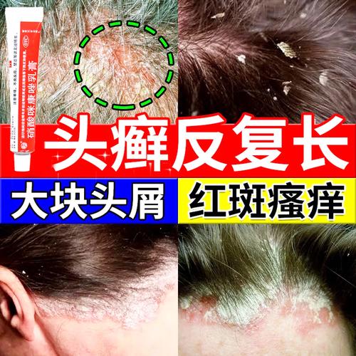 儿童头皮癣用药需谨慎，哪种药既安全又高效？家长该如何正确选择？-第2张图片-郑州医学网