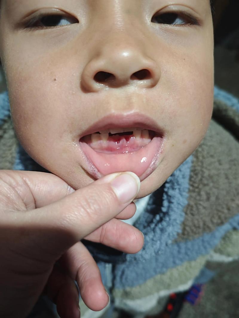 儿童换牙期恒牙未脱落就萌出，是何原因导致的？是否需要干预处理？-第1张图片-郑州医学网