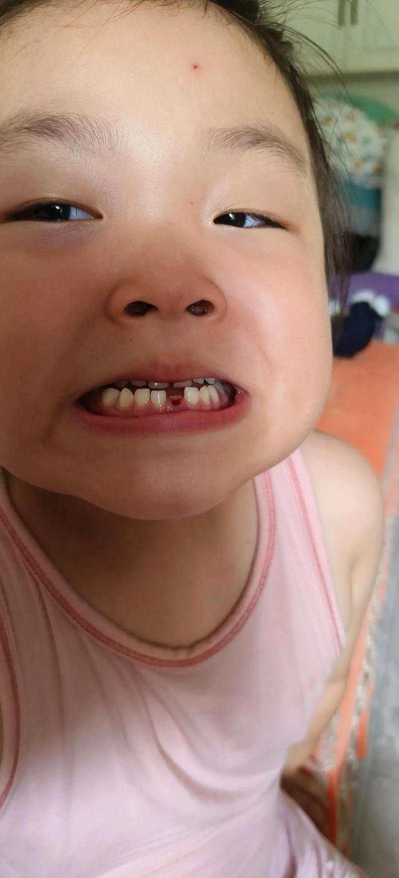 儿童换牙期恒牙未脱落就萌出，是何原因导致的？是否需要干预处理？-第3张图片-郑州医学网