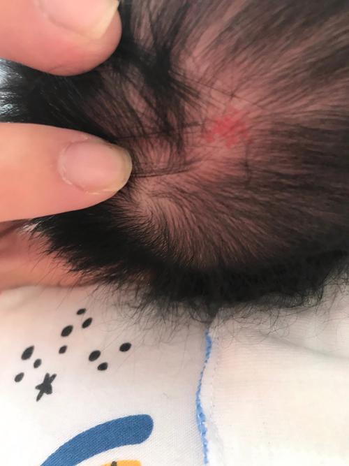 新生儿头皮血肿长时间不吸收怎么办？会影响发育吗？-第1张图片-郑州医学网