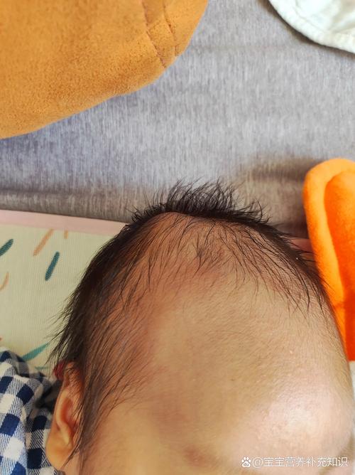 新生儿头皮血肿长时间不吸收怎么办？会影响发育吗？-第3张图片-郑州医学网