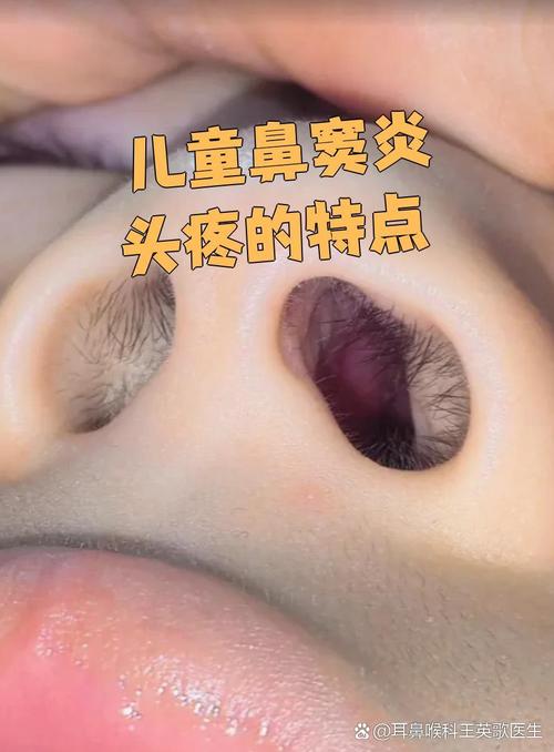 儿童鼻窦炎不治疗的话，长大后能自行痊愈吗？还是会留下后遗症？-第1张图片-郑州医学网