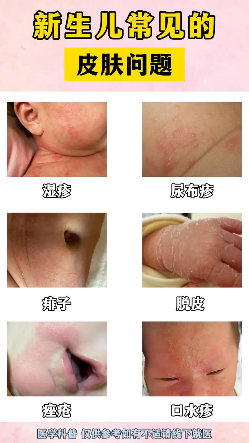 儿童湿疹频发,是过敏体质作祟还是日常护理疏漏所致?-第1张图片-郑州医学网 儿童湿疹频发,是过敏体质作祟还是日常护理疏漏所致?-第1张图片-郑州医学网