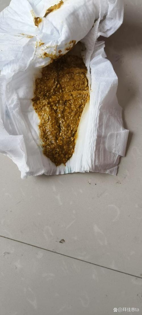 新生儿喝母乳后不排便，是攒肚还是便秘？需要干预吗？-第1张图片-郑州医学网