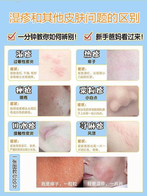 3岁儿童湿疹反复发作，该如何有效治疗并预防？-第3张图片-郑州医学网