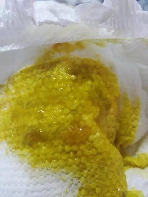 新生儿母乳大便带粘液是正常现象还是健康警报？-第1张图片-郑州医学网
