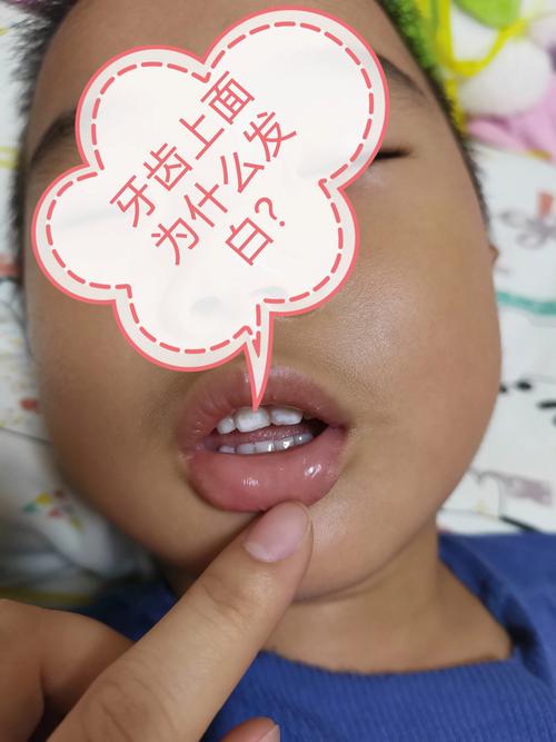 新生儿上牙龈发白图片是正常现象还是疾病信号？-第1张图片-郑州医学网