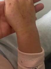 儿童再生性障碍性贫血的病因、治疗与预后有哪些关键问题？-第3张图片-郑州医学网