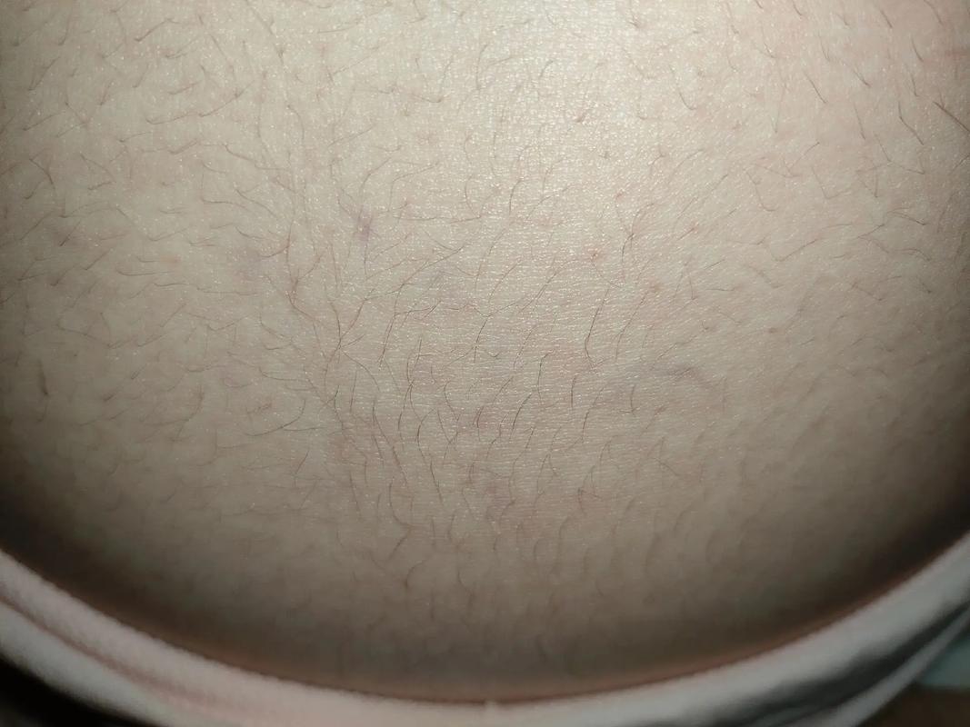 孕期肚脐眼周围凹进去-第3张图片-郑州医学网