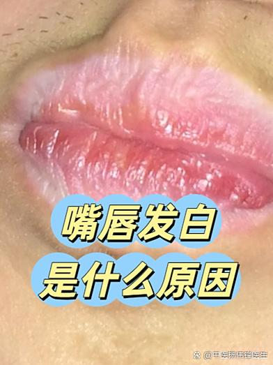 儿童嘴唇发白是贫血还是其他健康问题？需警惕哪些潜在疾病信号？-第2张图片-郑州医学网
