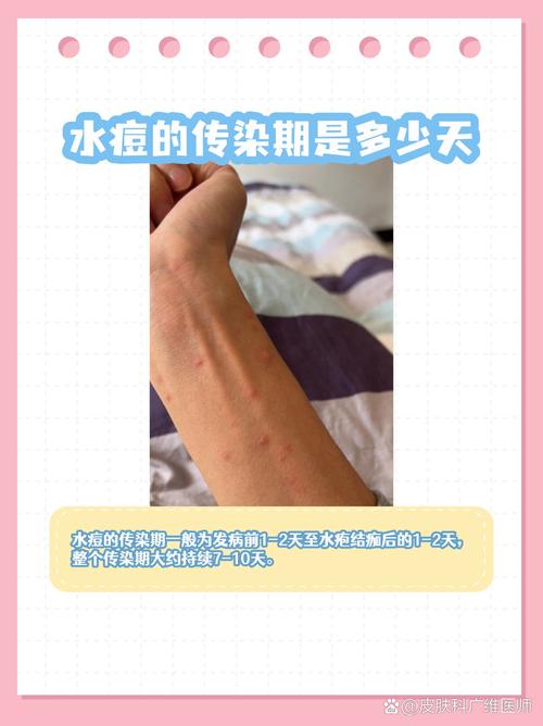 儿童水痘传染期具体有多长？不同阶段传染性有何差异？-第1张图片-郑州医学网