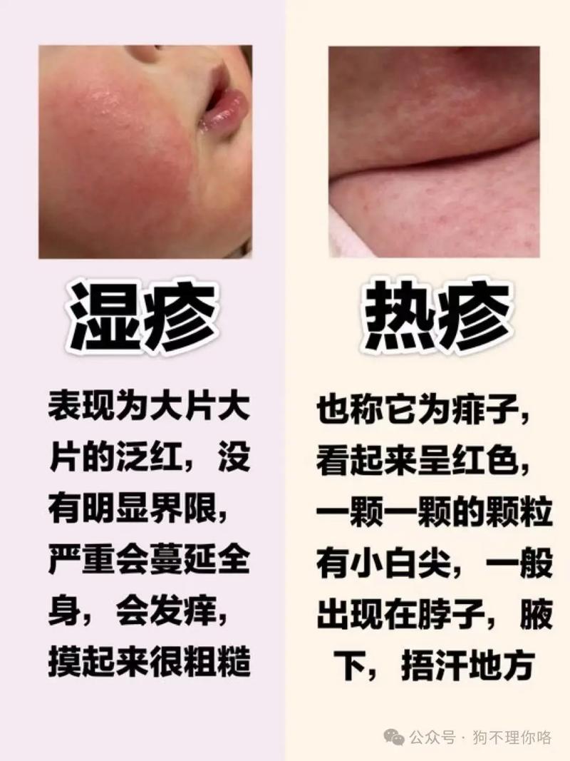 儿童过敏湿疹反反复复，家长该如何科学护理与有效治疗？-第1张图片-郑州医学网