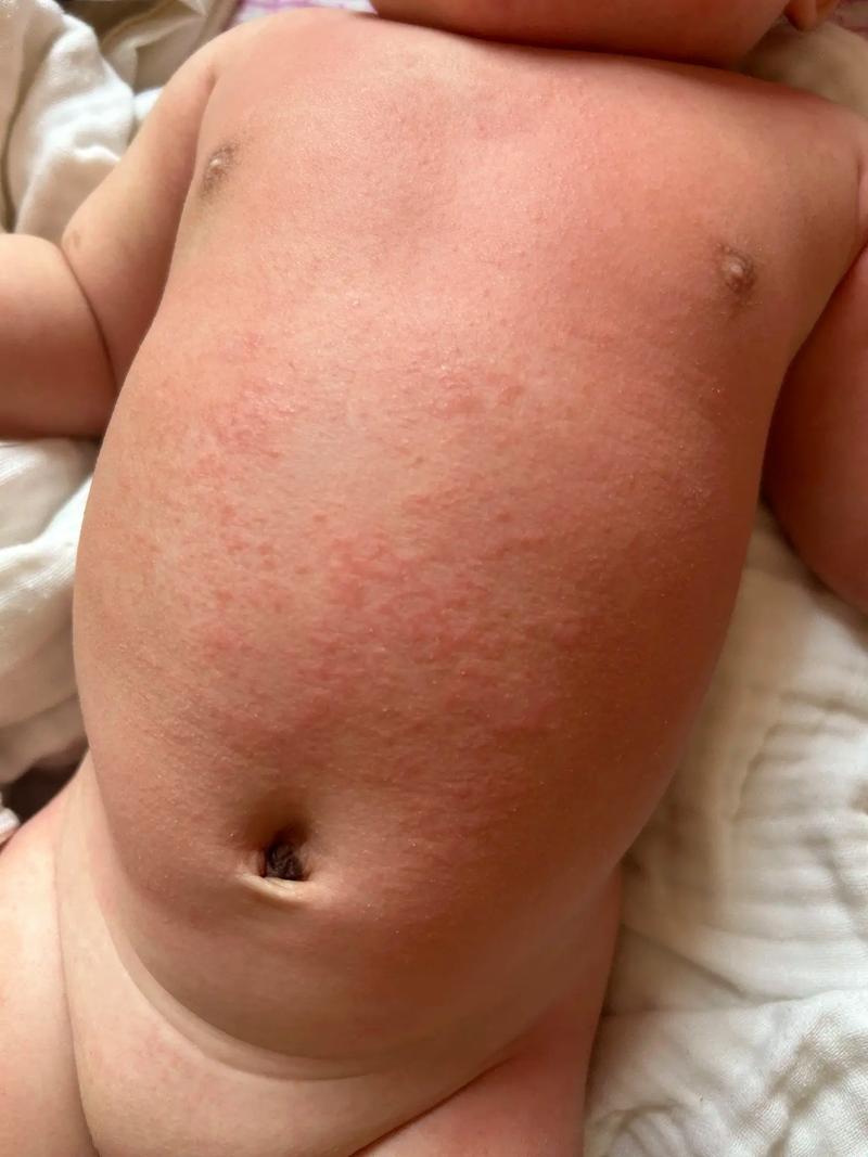 儿童过敏湿疹反反复复，家长该如何科学护理与有效治疗？-第2张图片-郑州医学网