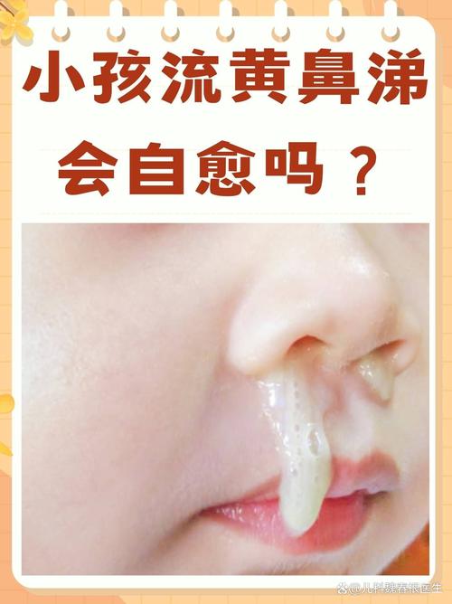 新生儿鼻涕多是感冒吗-第1张图片-郑州医学网