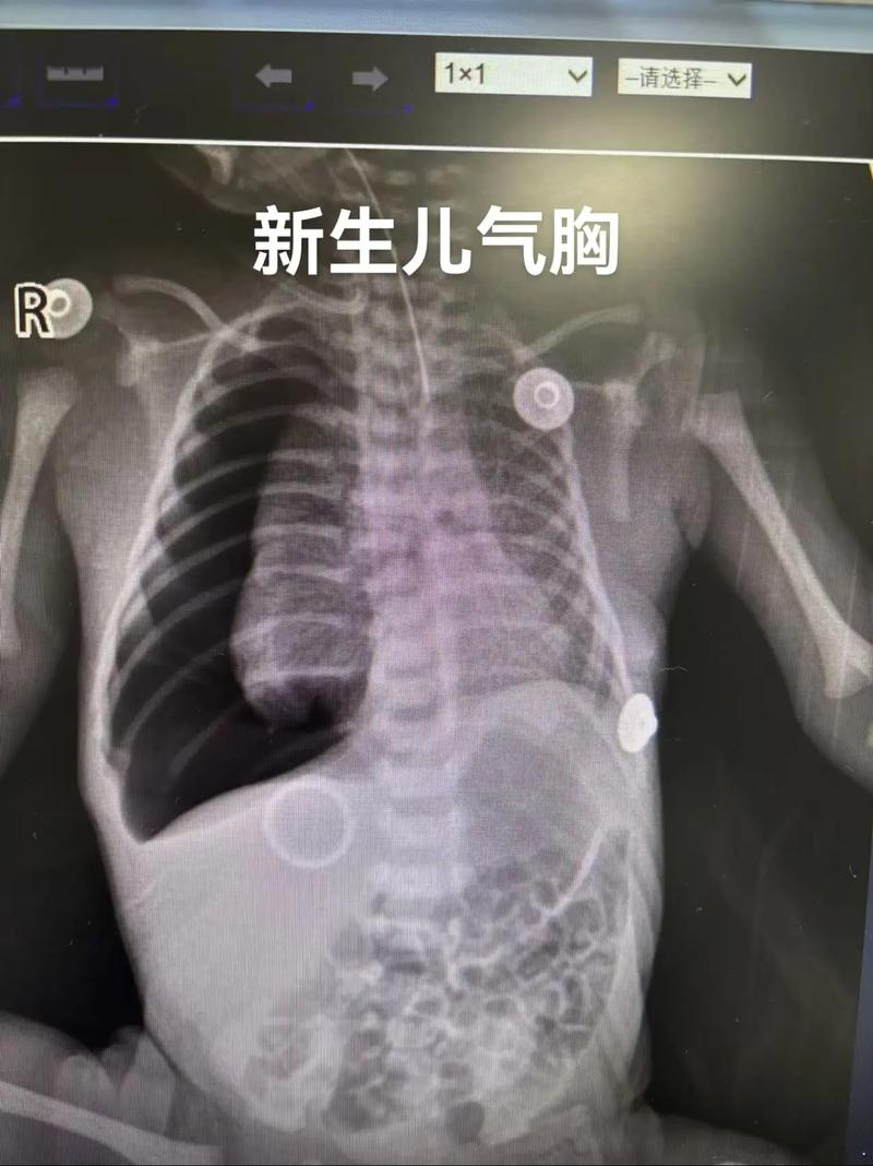 新生儿乳糜胸胸腔积液，病因、诊断与治疗全解析-第1张图片-郑州医学网