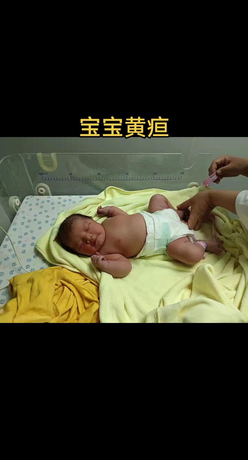 10天新生儿黄疸16mg/dl需要立即干预吗？-第3张图片-郑州医学网