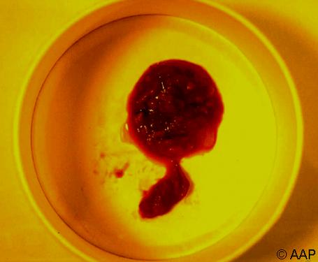 新生儿大便带红色黏液是感染还是肠道问题？需要立即就医吗？-第1张图片-郑州医学网