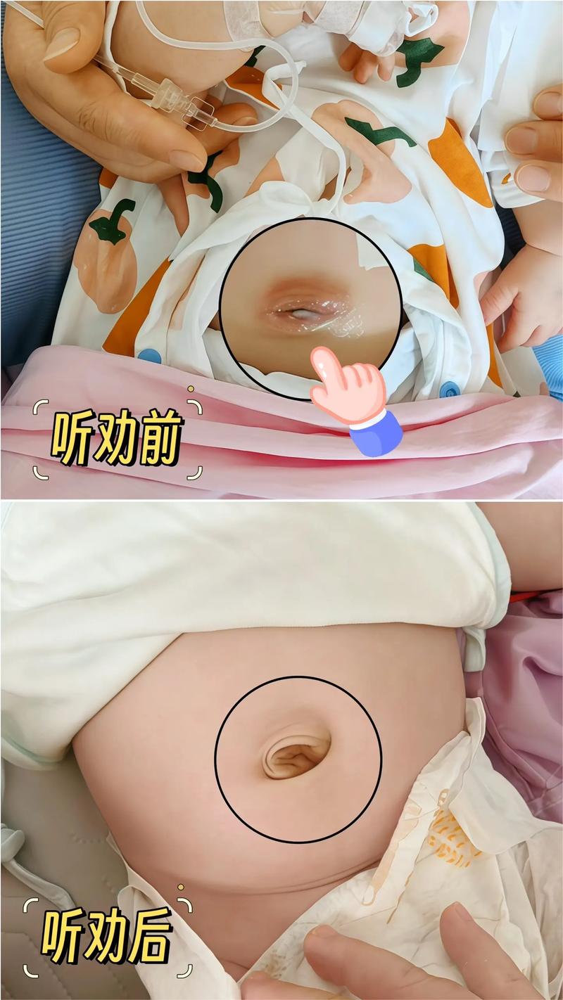 新生儿脐带脱落后，残留部分需要处理吗？护理不当会感染吗？-第2张图片-郑州医学网