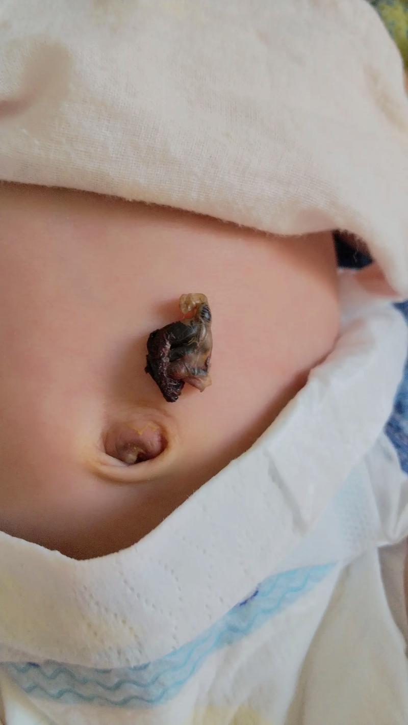 新生儿脐带脱落后，残留部分需要处理吗？护理不当会感染吗？-第1张图片-郑州医学网