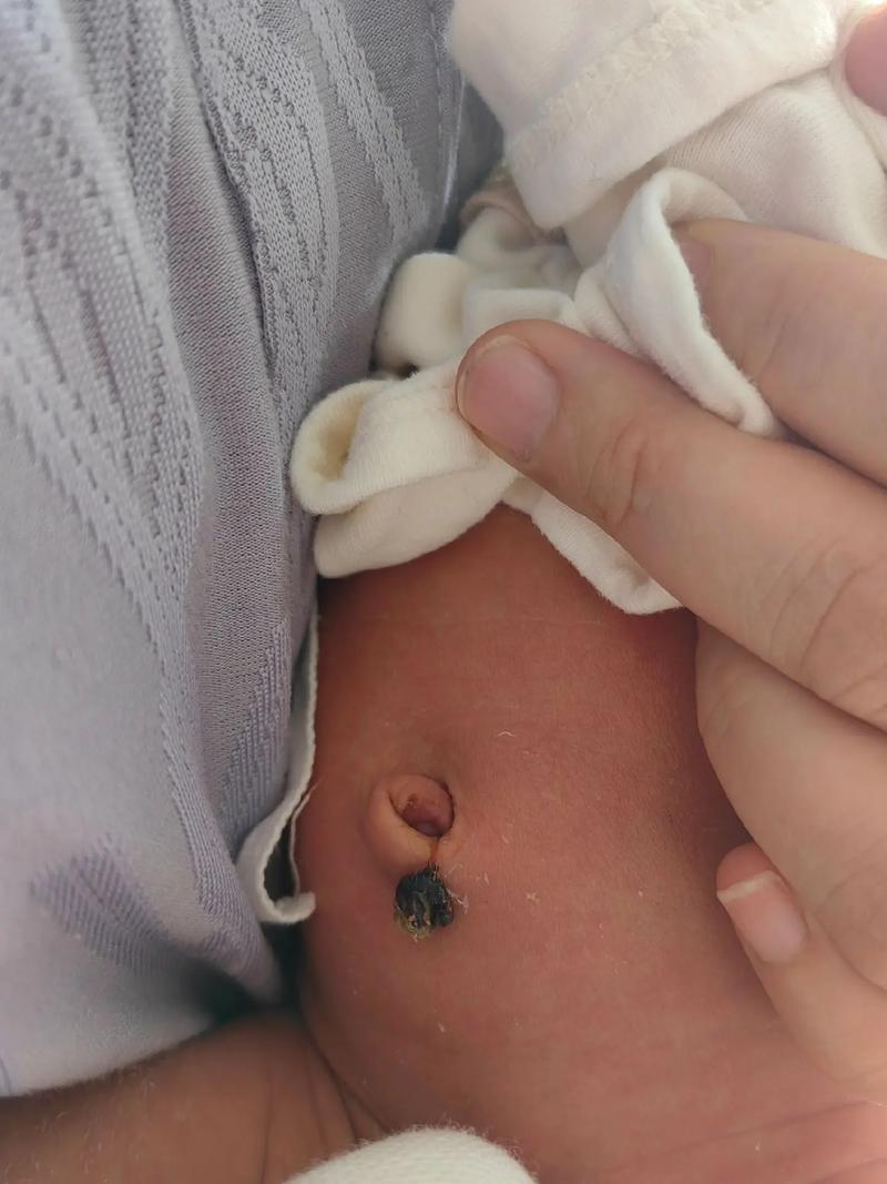 新生儿脐带脱落后，残留部分需要处理吗？护理不当会感染吗？-第3张图片-郑州医学网