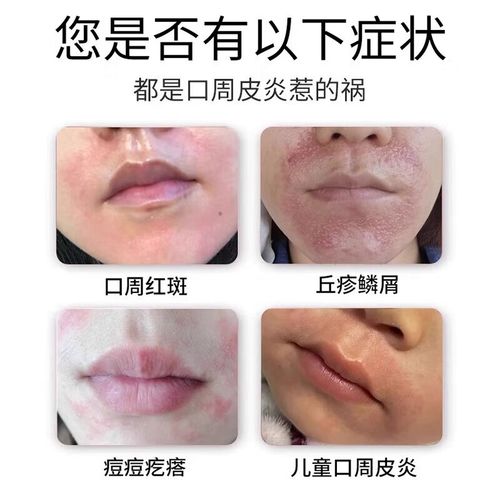 儿童下巴湿疹擦什么药-第1张图片-郑州医学网