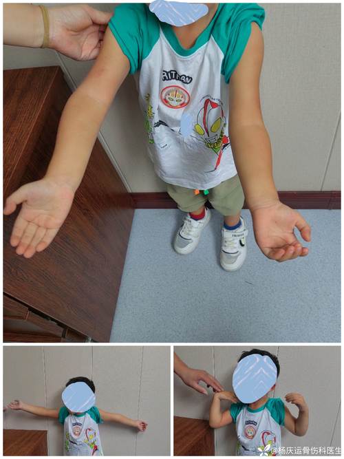 儿童肱骨髁上骨折后，何时开始锻炼？怎样锻炼才安全有效？-第1张图片-郑州医学网