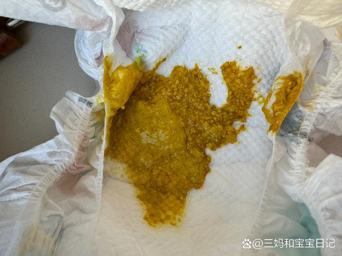 新生儿每天频繁拉粑粑,是正常生理现象还是健康预警信号?-第2张图片-郑州医学网 新生儿每天频繁拉粑粑,是正常生理现象还是健康预警信号?-第2张图片-郑州医学网