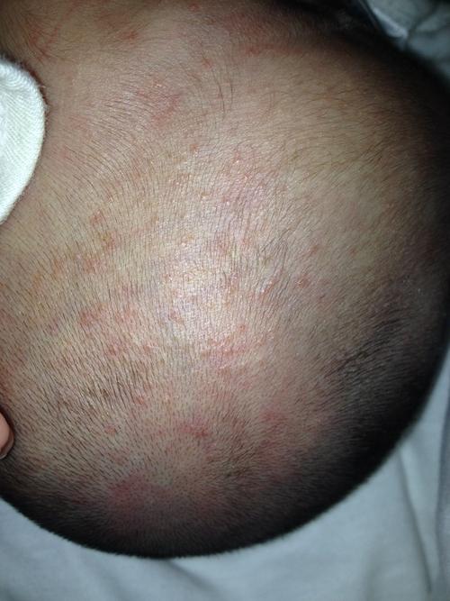 新生儿头皮出现小红疙瘩是湿疹还是毛囊炎?该怎么护理?-第2张图片-郑州医学网 新生儿头皮出现小红疙瘩是湿疹还是毛囊炎?该怎么护理?-第2张图片-郑州医学网