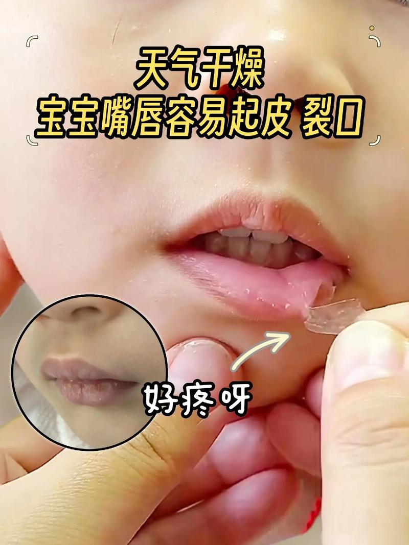 新生儿嘴唇干裂怎么办？日常护理有哪些注意事项？-第1张图片-郑州医学网