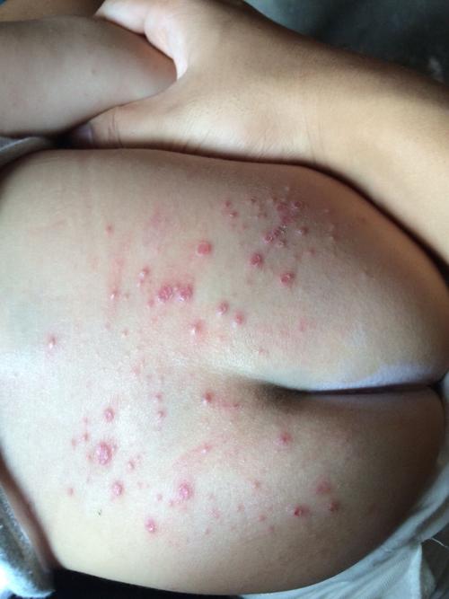 新生儿屁眼旁边起疙瘩是啥原因？需要担心吗？-第1张图片-郑州医学网