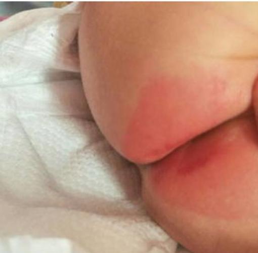 新生儿屁眼旁边起疙瘩是啥原因？需要担心吗？-第3张图片-郑州医学网