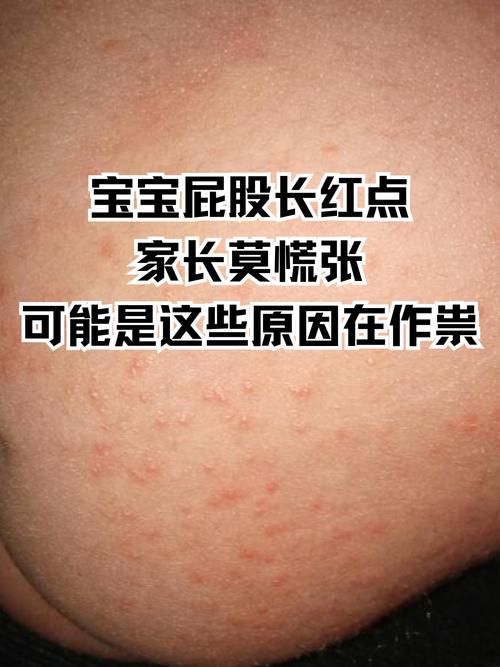 新生儿屁眼旁边起疙瘩是啥原因？需要担心吗？-第2张图片-郑州医学网