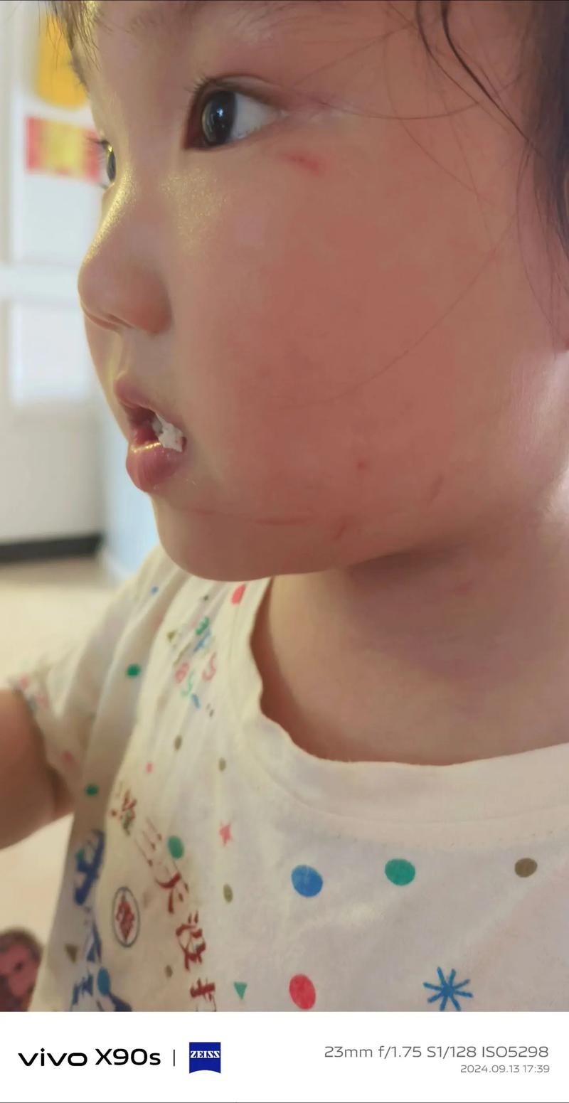 新生儿脸上抓破涂什么-第1张图片-郑州医学网