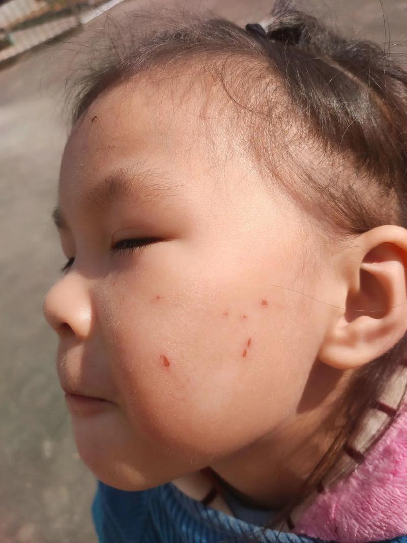 新生儿脸上抓破涂什么-第2张图片-郑州医学网